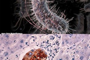  Бактерии взяли след диабета и рака  